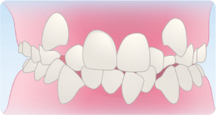 叢生（そうせい）