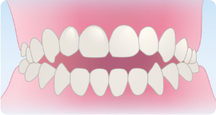 開咬（かいこう）