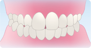 交差咬合（こうさこうごう）